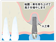 サイナスリフト